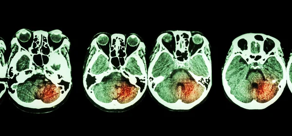 Acidente vascular cerebral (tomografia computadorizada do cérebro e base do crânio e acidente vascular cerebral  ) — Fotografia de Stock