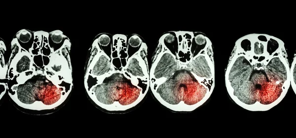 Acidente vascular cerebral (tomografia computadorizada do cérebro e base do crânio e acidente vascular cerebral  ) — Fotografia de Stock