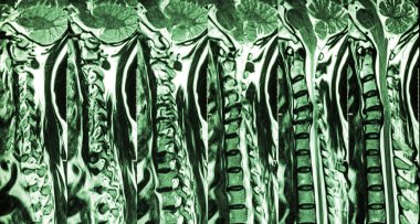 Disk hernisi olan servikal spondilozis ( Servikal omurganın Mri ' si : disk hernisi komponent spinal kord ile servikal spondiloz göstermek ( Miyelopati ) )