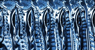 Disk hernisi olan servikal spondilozis ( Servikal omurganın Mri ' si : disk hernisi komponent spinal kord ile servikal spondiloz göstermek ( Miyelopati ) )