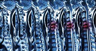 Disk hernisi olan servikal spondilozis ( Servikal omurganın Mri ' si : disk hernisi komponent spinal kord ile servikal spondiloz göstermek ( Miyelopati ) )