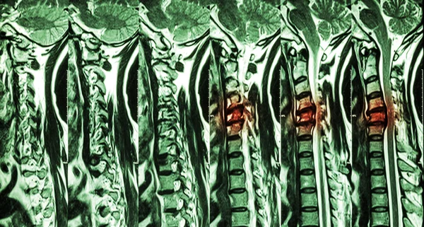 Spondyloza szyjki macicy z przepukliną tarczową (MRI kręgosłupa szyjnego: Pokaż kręgosłupa szyjki macicy z krążkiem hermetyzacji kompresji rdzenia kręgowego (mielopatia ) ) — Zdjęcie stockowe