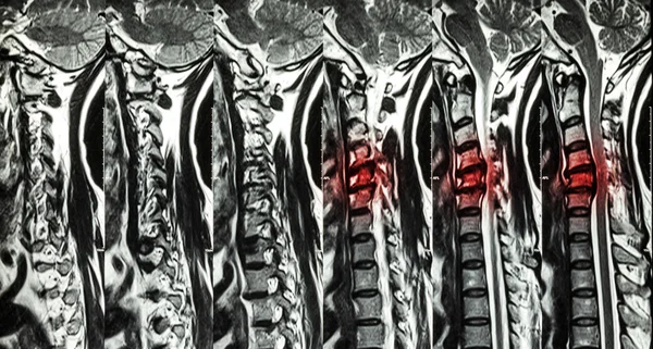 Cervicale spondylose met schijf hernia (MRI van cervicale wervelkolom: Toon cervicale spondylose met schijf hernia Comprimeer het ruggenmerg (Myelopathie ) ) — Stockfoto