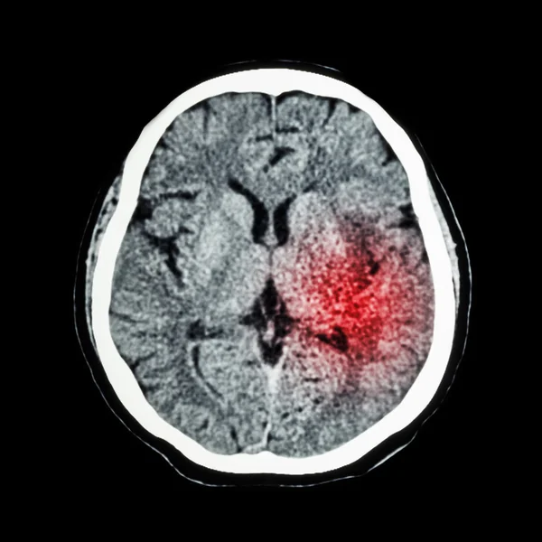 A tomografia computadorizada do cérebro mostra acidente vascular cerebral isquêmico ou acidente vascular cerebral hemorrágico — Fotografia de Stock