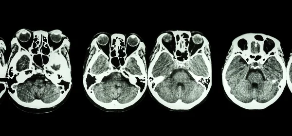 CT scan of brain and base of skull ( show structure of eye , ethmoid sinus , cerebellum , cerebrum, etc ) — Stock Photo, Image