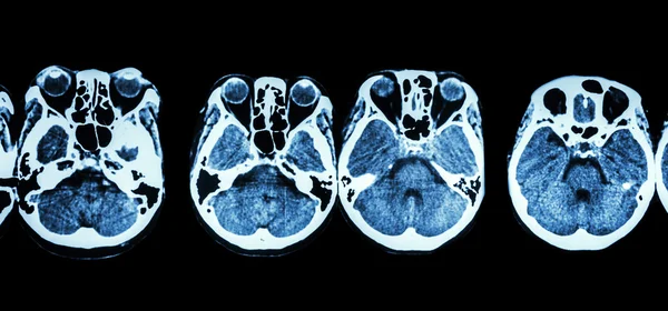 CT-scan van de hersenen en de basis van de schedel (Toon structuur van het oog, ethmoïde sinus, cerebellum, cerebrum, enz ) — Stockfoto