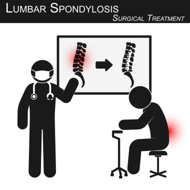 Doktor lomber spondilozun cerrahi tedavisi hakkında bilgi ve omurga görüntüleme (plaka ve vida ile iç fiksasyon ile operasyon öncesi ve sonrası ) ( stickman vektör ) ( Omurga bakım kavramı )