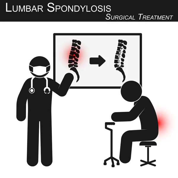 El médico explica sobre el tratamiento quirúrgico de la espondilosis lumbar y muestra imágenes de la columna vertebral (antes y después de la operación por fijación interna con placa y tornillo) (vector stickman) (concepto de cuidado de la columna vertebral  ) — Archivo Imágenes Vectoriales