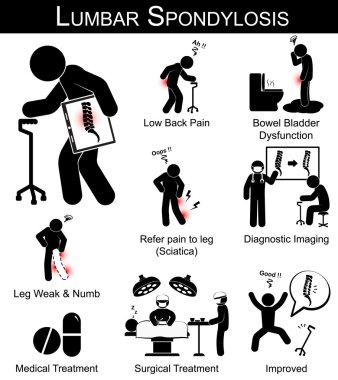 Lumbar Spondylosis symptoms pictogram ( Low back pain , refer pain to leg , leg numbness and weakness , Bowel bladder dysfunction ) and Medical , Surgical treatment clipart