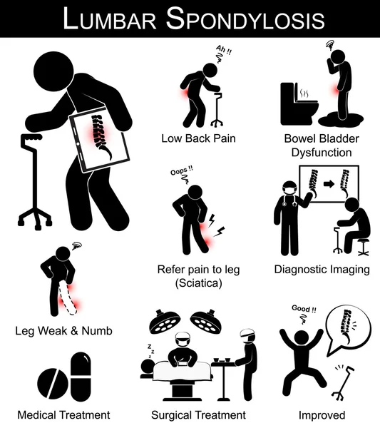 Pictograma de síntomas de espondilosis lumbar (dolor lumbar, referir el dolor a la pierna, entumecimiento y debilidad de la pierna, disfunción de la vejiga intestinal) y tratamiento médico, quirúrgico — Vector de stock