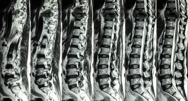 Rezonance bederní páteře & hrudníku: Zobrazit frakturu hrudní páteře a zhuštění míchy (myelopathy ) — Stock fotografie