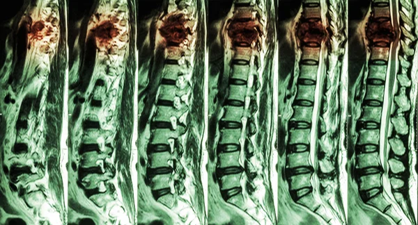 IRM de la colonne lombaire et thoracique : fracture de la colonne thoracique et compression de la moelle épinière (myélopathie  ) — Photo