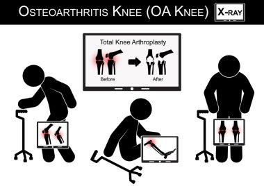 Dizinde yaşlı adam ağrısı , Monitör Toplam diz artroplastisi görüntü göstermek ( öncesi ve cerrahi tedavi sonrası ) Osteoartrit diz vektörü ( düz tasarım ) ( Sağlık kavramı )