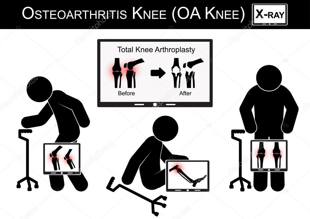 Old man pain at his knee , Monitor show image of Total knee arthroplasty ( before and after surgical treatment ) Osteoarthritis knee vector ( flat design ) ( Health care concept )