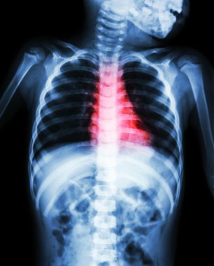 Konjenital Kalp Hastalığı , Romatizmal Kalp Hastalığı ( Kalp bölgesinde çocuk ve kırmızı renk x-Ray vücut )