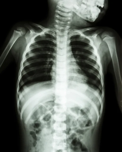 Chest X-ray of child show neck , thorax , shoulder , arm , abdomen — Stock Photo, Image