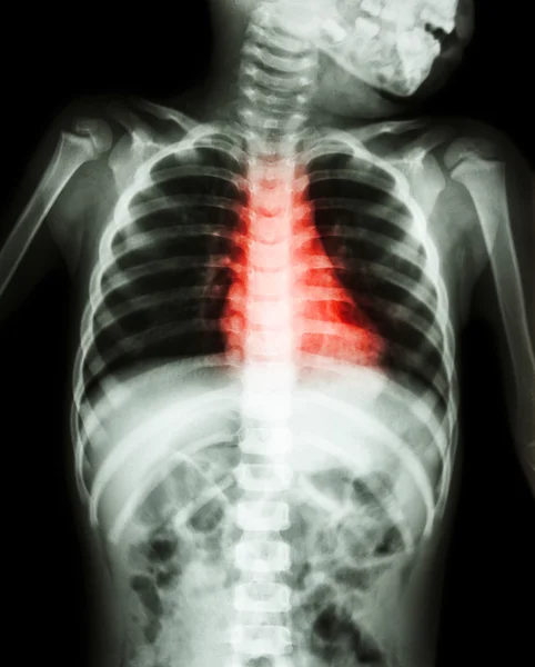 Vrozené onemocnění srdce, revmatické onemocnění srdce (rentgenové tělo dítěte a červená barva na srdeční ploše ) — Stock fotografie
