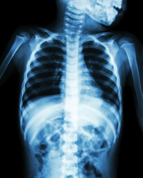 儿童胸部 x 光显示颈部、 胸部、 肩膀、 手臂、 腹部 — 图库照片