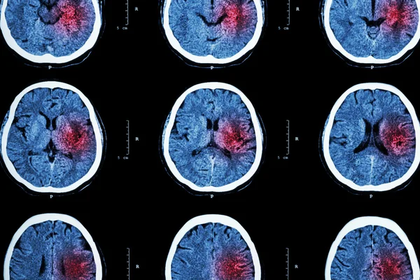 CT scan mozku s červenou plochou (Imaging pro hemorrhagický tah nebo koncept ischemického tahu (myokardu) ) — Stock fotografie