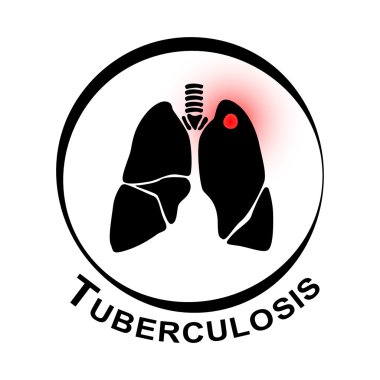 Pulmoner Tüberküloz Sembolü ( Mycobacterium Tuberculosis enfeksiyonuna bağlı sol üst lobda kavite olan akciğer )