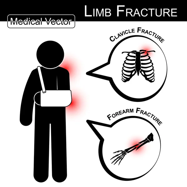 Stick homme avec bras (clavicule et fracture de l'avant-bras) et bulle de texte (Médical, Santé, vecteur de soins de santé  ) — Image vectorielle