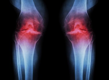 Osteoartrit Diz ( Oa Diz ) ( Film x-ray diz eklemartriti ile her iki diz : dar diz eklem alanı ) ( Tıp ve Bilim arka plan )
