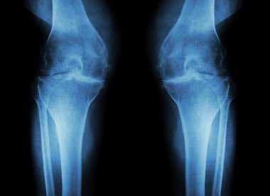 Osteoarthritis Knee ( OA Knee ) ( Film x-ray both knee with arthritis of knee joint : narrow knee joint space ) ( Medical and Science background ) clipart