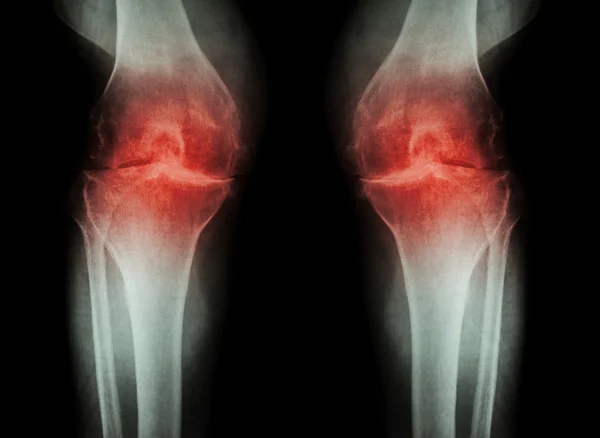 Osteoartrit Diz ( Oa Diz ) ( Film x-ray diz eklemartriti ile her iki diz : dar diz eklem alanı ) ( Tıp ve Bilim arka plan ) — Stok fotoğraf