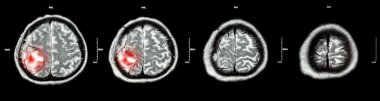 Brain tumor  ( Film CT-scan of brain : show part of brain with tumor ) clipart