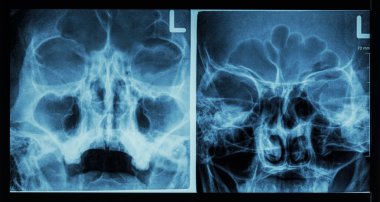 Film x-ray paranasal sinus show frontal sinus , maxillary sinus , ethmoid sinus  clipart