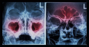 Film X-ray paranasal sinus : show sinusitis at maxillary sinus ( left image ) , frontal sinus ( right image ) clipart