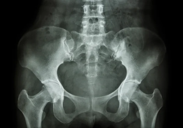 Film X-ray of Pelvis — Stock Photo, Image