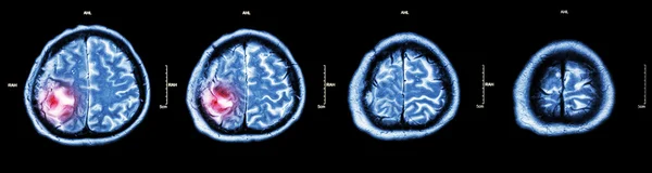 Tumore al cervello (TAC al film del cervello: mostra parte del cervello con tumore  ) — Foto Stock