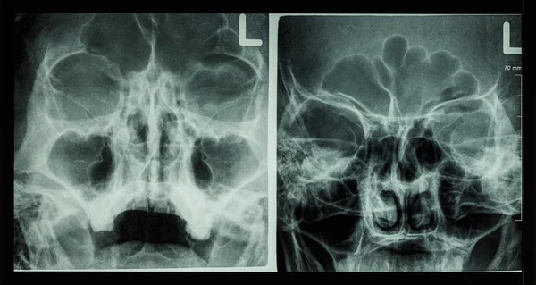 薄膜 x 射线鼻旁窦显示额窦、 上颌窦、 筛窦 — 图库照片
