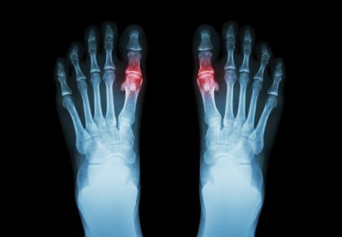 Gout , Rheumatoid arthritis ( Film x-ray both foot and arthritis at first metatarsophalangeal joint ) ( Medicine and Science background ) clipart