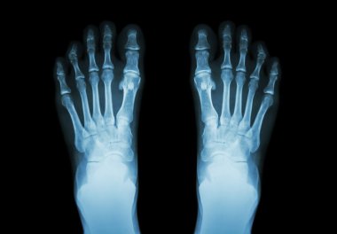 Film x-ray her iki ayak ( ön görünüm )