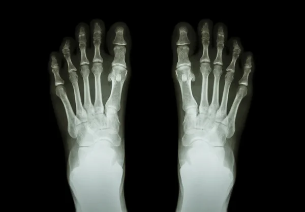 Film x-ray obě chodidla (pohled zepředu ) — Stock fotografie