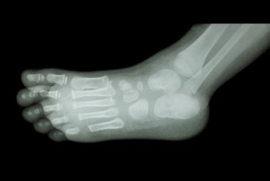film x-ray çocuk ayak ( yan görünüm ) ( lateral )