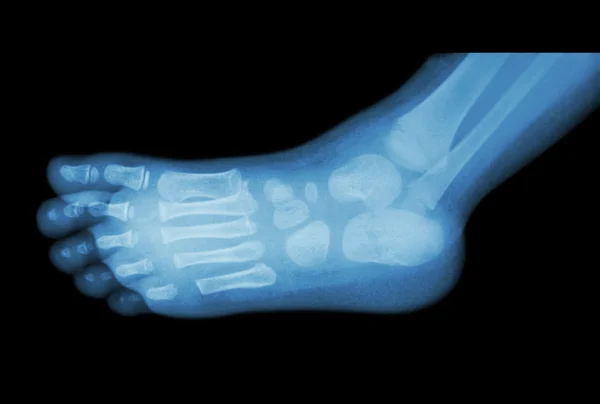 Film x-ray av barnets fot (sidovy) (lateral ) — Stockfoto