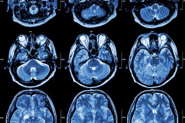 Mrg of Brain ( beynin kesiti ) ( Tıp , Sağlık , Bilim arka plan )