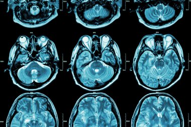 Mrg of Brain ( beynin kesiti ) ( Tıp , Sağlık , Bilim arka plan )