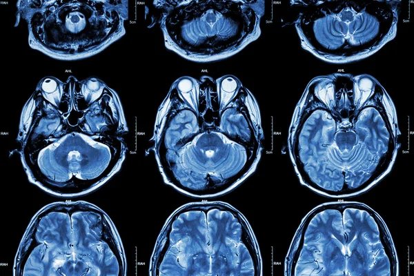 MRI of Brain (seção transversal do cérebro) (Médico, Cuidados de saúde, Ciência de fundo  ) — Fotografia de Stock