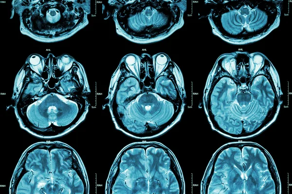 MRI of Brain (cross section of brain) (Medical, Health care, Science background  ) — стоковое фото