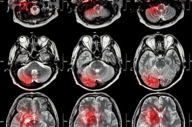 Film MRI (manyetik rezonans görüntüleme) beyin (inme, beyin tümörü, beyin enfarktüsü, intraserebral kanama) (tıp, sağlık kaygı, bilim arka plan) (beyin kesiti) Fil