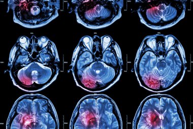 Film Mri ( Manyetik rezonans görüntüleme ) beyin ( inme , beyin tümörü , serebral enfarktüs , intraserebral kanama ) ( Tıbbi , Sağlık , Bilim Arka Plan ) ( Beynin kesiti )