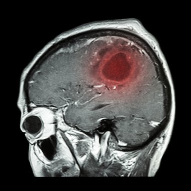 Beyin tümörü ile beyin Filmi Mri ( Sagittal düzlem , yan görünüm , lateral görünüm ) ( Tıp , Sağlık , Bilim Arka Plan )