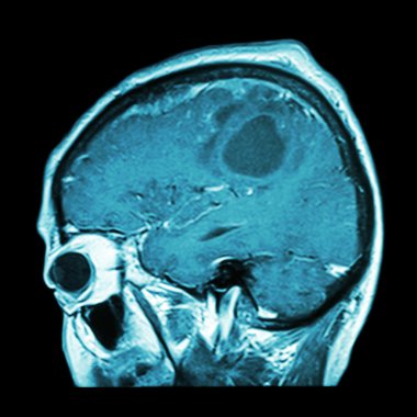 Beyin tümörü ile beyin Filmi Mri ( Sagittal düzlem , yan görünüm , lateral görünüm ) ( Tıp , Sağlık , Bilim Arka Plan )