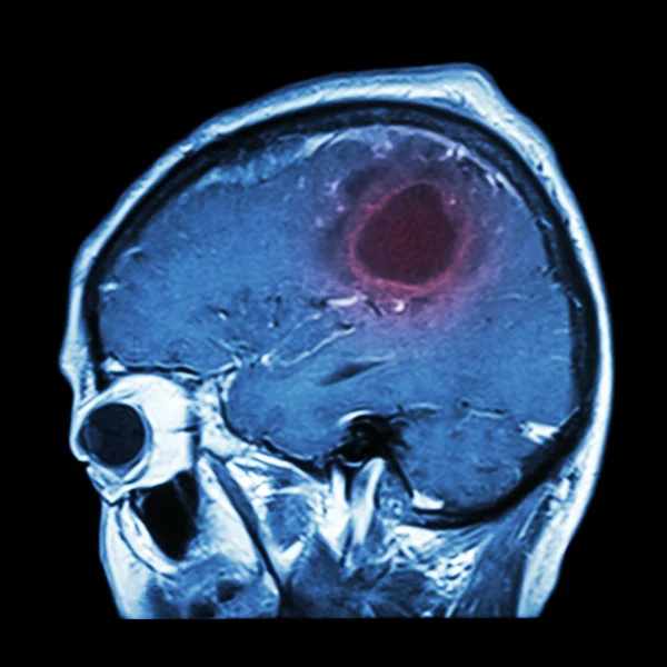 Filma MRI av hjärnan med hjärntumör (sagittal plan, sidovy, lateral visning) (medicinsk, hälsovård, vetenskap bakgrund ) — Stockfoto