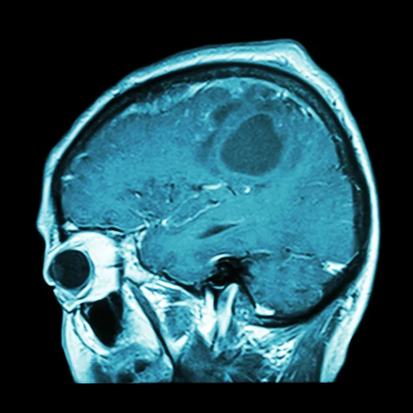 Filma MRI av hjärnan med hjärntumör (sagittal plan, sidovy, lateral visning) (medicinsk, hälsovård, vetenskap bakgrund ) — Stockfoto