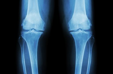 Osteoarthritis Knee ( OA Knee ). Film x-ray both knee ( front view ) show narrow joint space ( joint cartilage loss ) , osteophyte , subchondral sclerosis clipart